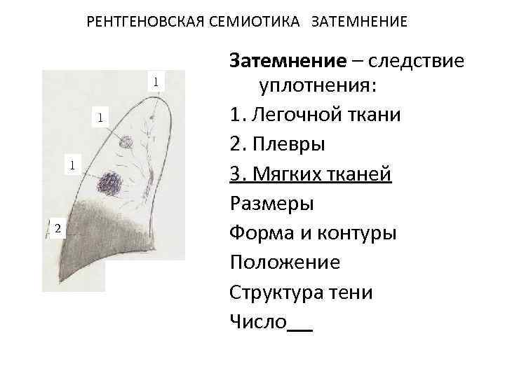 РЕНТГЕНОВСКАЯ СЕМИОТИКА ЗАТЕМНЕНИЕ 1 1 1 2 Затемнение – следствие уплотнения: 1. Легочной ткани