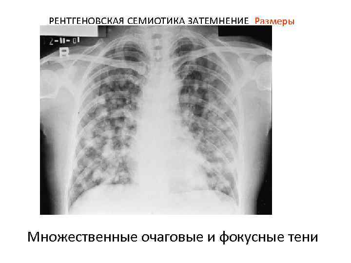 РЕНТГЕНОВСКАЯ СЕМИОТИКА ЗАТЕМНЕНИЕ Размеры Множественные очаговые и фокусные тени 