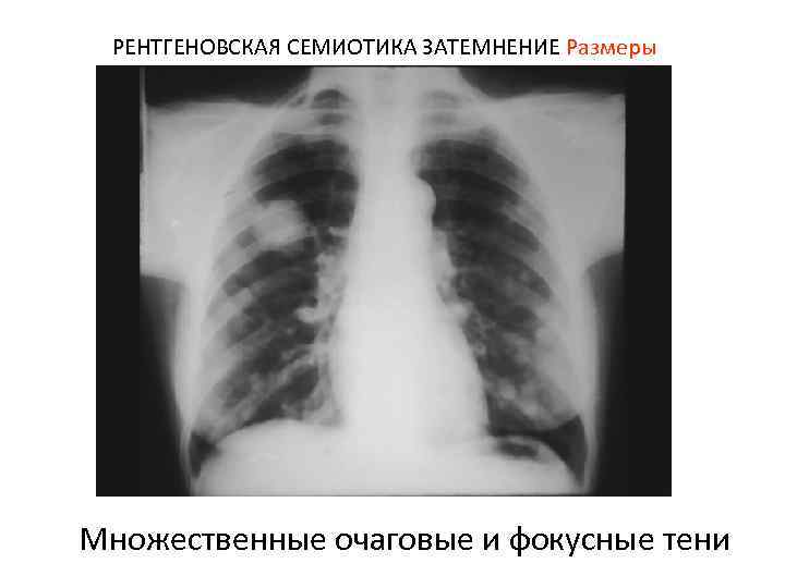 РЕНТГЕНОВСКАЯ СЕМИОТИКА ЗАТЕМНЕНИЕ Размеры Множественные очаговые и фокусные тени 