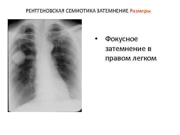 РЕНТГЕНОВСКАЯ СЕМИОТИКА ЗАТЕМНЕНИЕ Размеры • Фокусное затемнение в правом легком 
