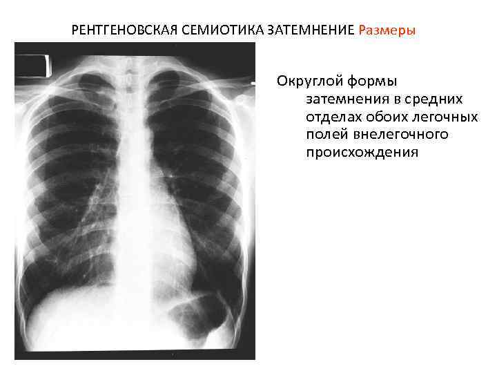 РЕНТГЕНОВСКАЯ СЕМИОТИКА ЗАТЕМНЕНИЕ Размеры Округлой формы затемнения в средних отделах обоих легочных полей внелегочного
