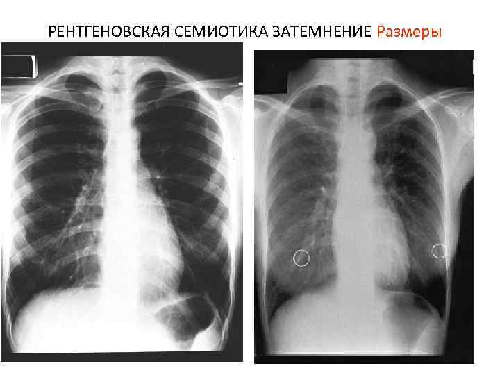 РЕНТГЕНОВСКАЯ СЕМИОТИКА ЗАТЕМНЕНИЕ Размеры 