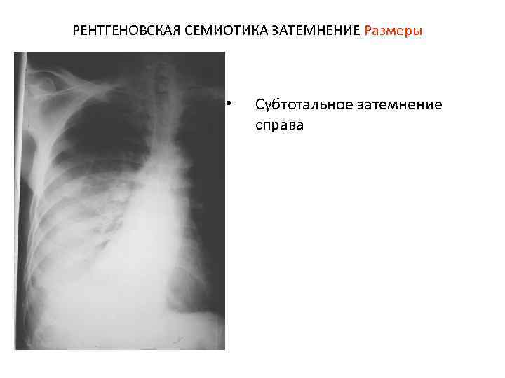 РЕНТГЕНОВСКАЯ СЕМИОТИКА ЗАТЕМНЕНИЕ Размеры • Субтотальное затемнение справа 