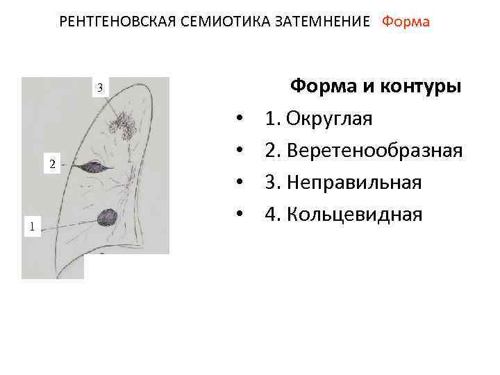 РЕНТГЕНОВСКАЯ СЕМИОТИКА ЗАТЕМНЕНИЕ Форма 3 2 1 • • Форма и контуры 1. Округлая