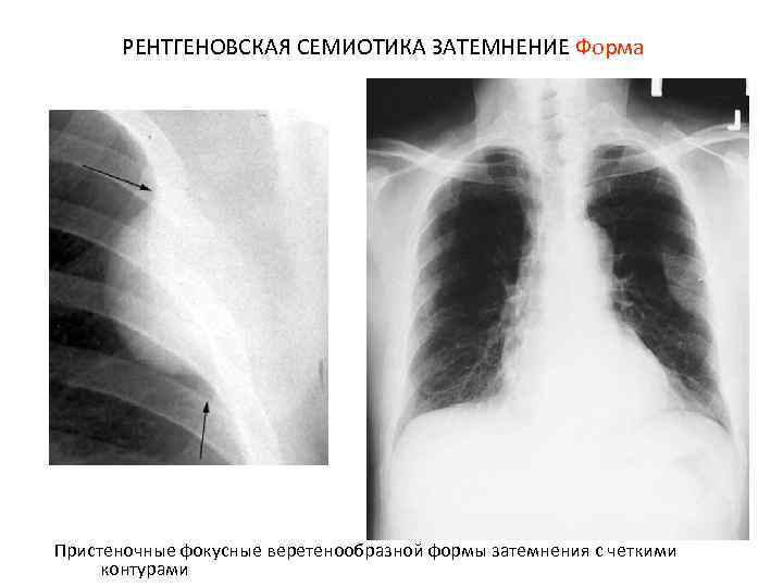 РЕНТГЕНОВСКАЯ СЕМИОТИКА ЗАТЕМНЕНИЕ Форма Пристеночные фокусные веретенообразной формы затемнения с четкими контурами 