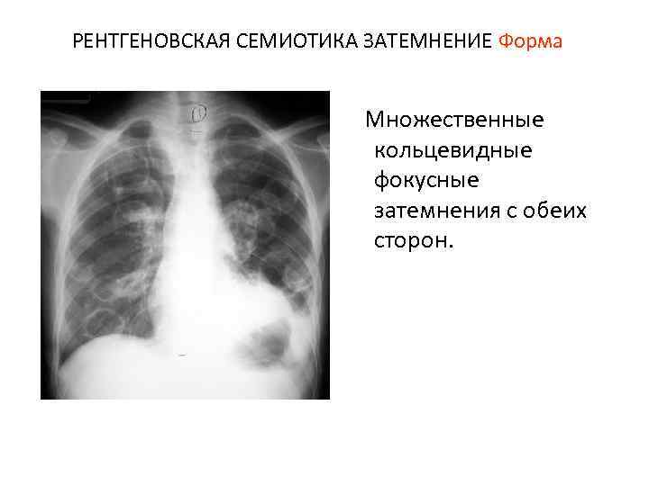 РЕНТГЕНОВСКАЯ СЕМИОТИКА ЗАТЕМНЕНИЕ Форма Множественные кольцевидные фокусные затемнения с обеих сторон. 