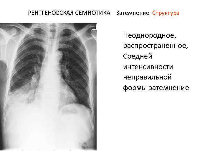 РЕНТГЕНОВСКАЯ СЕМИОТИКА Затемнение Структура Неоднородное, распространенное, Средней интенсивности неправильной формы затемнение 