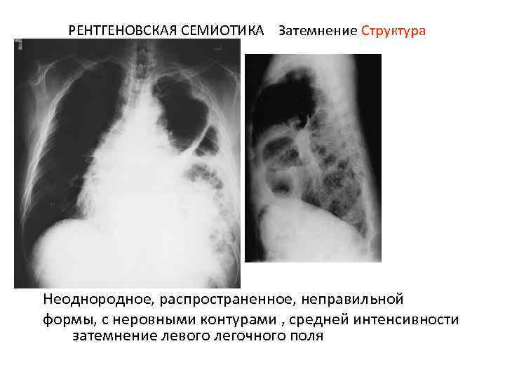 РЕНТГЕНОВСКАЯ СЕМИОТИКА Затемнение Структура Неоднородное, распространенное, неправильной формы, с неровными контурами , средней интенсивности