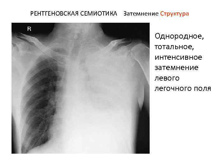 РЕНТГЕНОВСКАЯ СЕМИОТИКА Затемнение Структура Однородное, тотальное, интенсивное затемнение левого легочного поля 