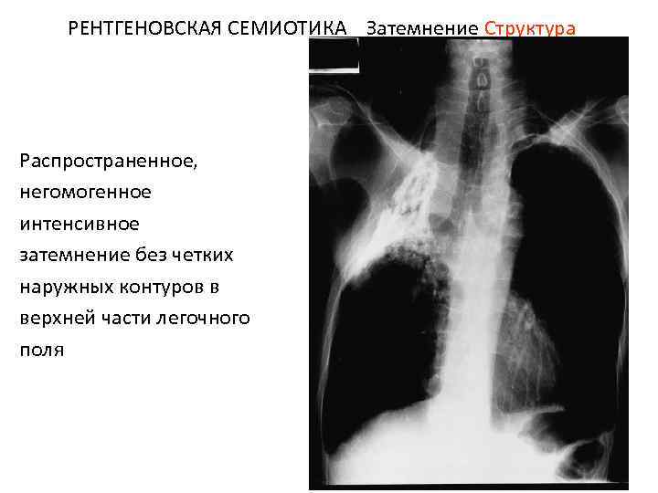 РЕНТГЕНОВСКАЯ СЕМИОТИКА Затемнение Структура Распространенное, негомогенное интенсивное затемнение без четких наружных контуров в верхней
