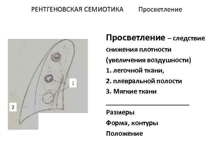 РЕНТГЕНОВСКАЯ СЕМИОТИКА Просветление – следствие 1 2 снижения плотности (увеличения воздушности) 1. легочной ткани,