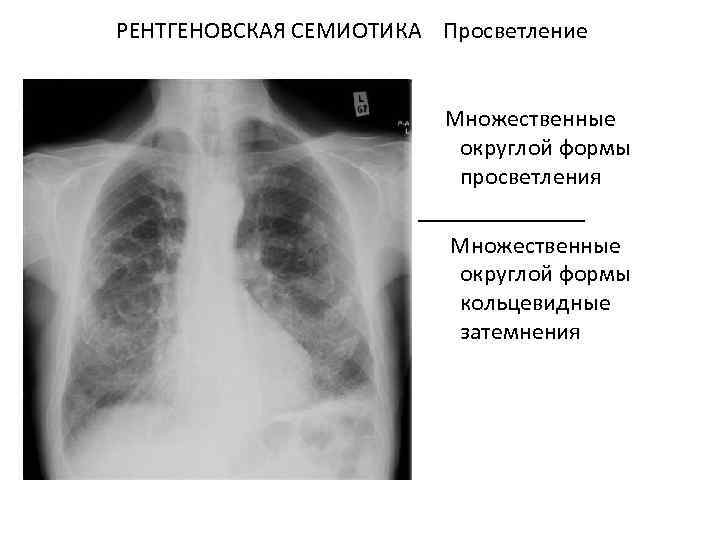 РЕНТГЕНОВСКАЯ СЕМИОТИКА Просветление Множественные округлой формы просветления _______ Множественные округлой формы кольцевидные затемнения 