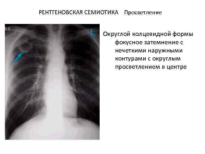 Образование округлой формы с четкими ровными контурами