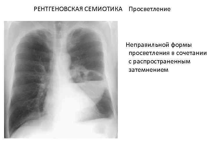 РЕНТГЕНОВСКАЯ СЕМИОТИКА Просветление Неправильной формы просветления в сочетании с распространенным затемнением 