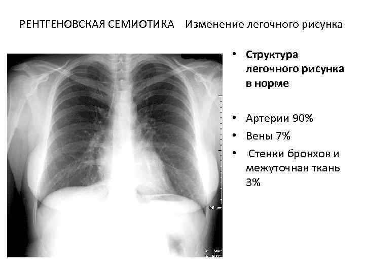 Изменение легочного рисунка