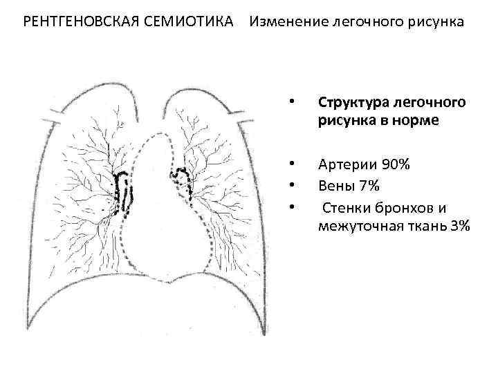 Что означает легочный рисунок. Изменение легочного рисунка. Патологические изменения легочного рисунка. Структуры легочного рисунка. Легочный рисунок в норме.