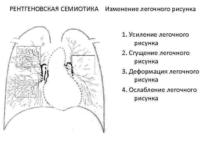 Расширенный легочный рисунок. Деформация корней легочного рисунка. Легочный рисунок деформирован. Легочный рисунок сгущен. Усиленный легочный рисунок.