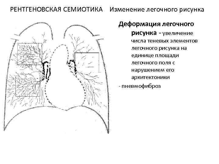 Усиленный рисунок легких на рентгене