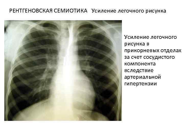 Усиление деформация легочного рисунка что это на рентгене