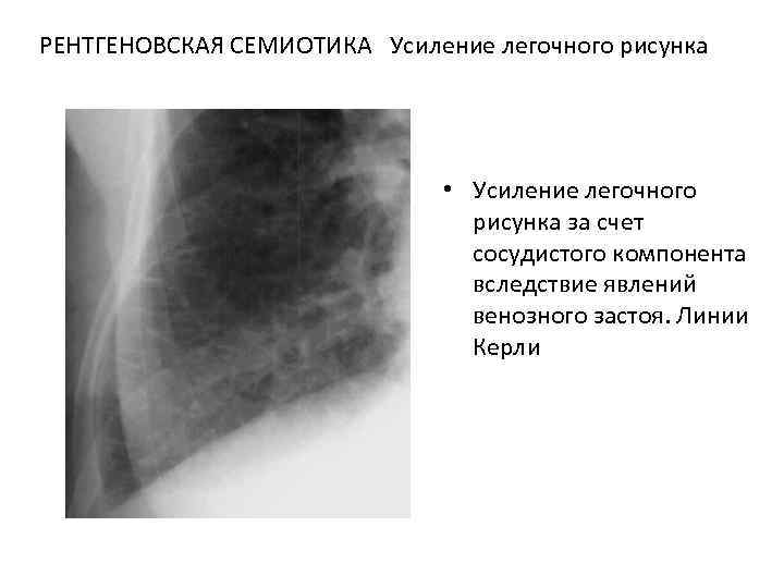 Усилен легочный рисунок за счет сосудистого компонента что