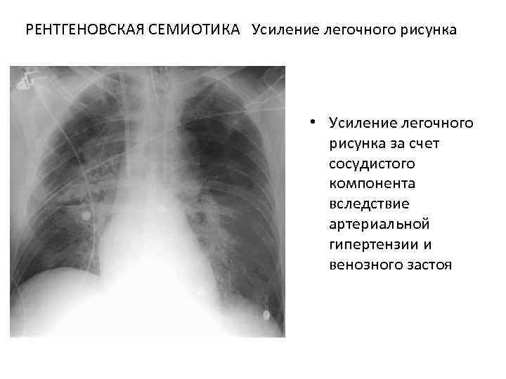 Легочный рисунок обогащен за счет сосудистого компонента что это значит