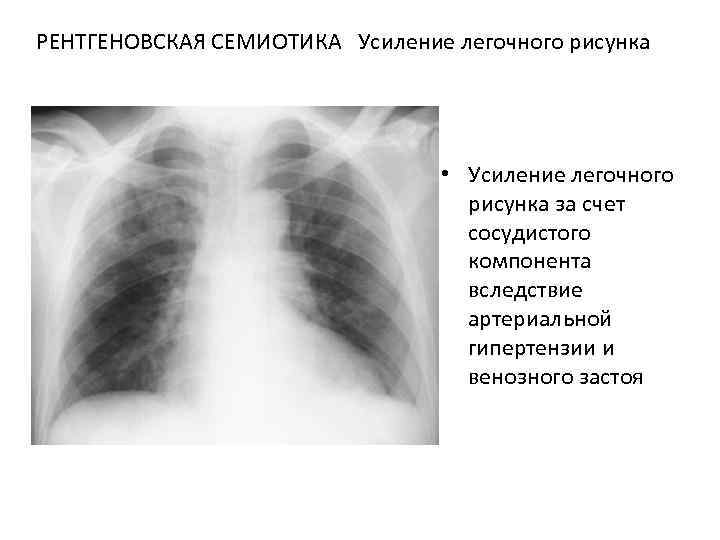 Усиление легочного рисунка что