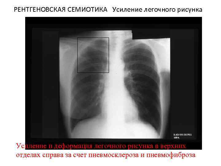 Усиление легочного рисунка на рентгене форум