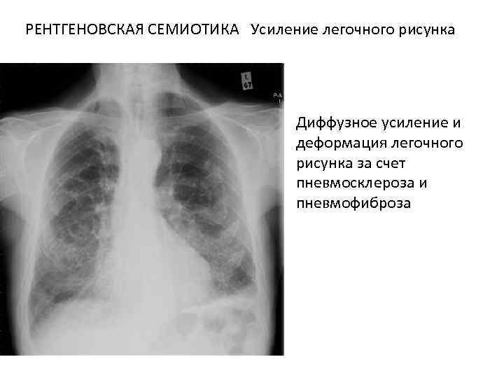 Легочный рисунок усилен деформирован. Усиление легочного рисунка. Усил ение логочного рисунка. Умтление легосного рисунка. Легочный рисунок усилен.