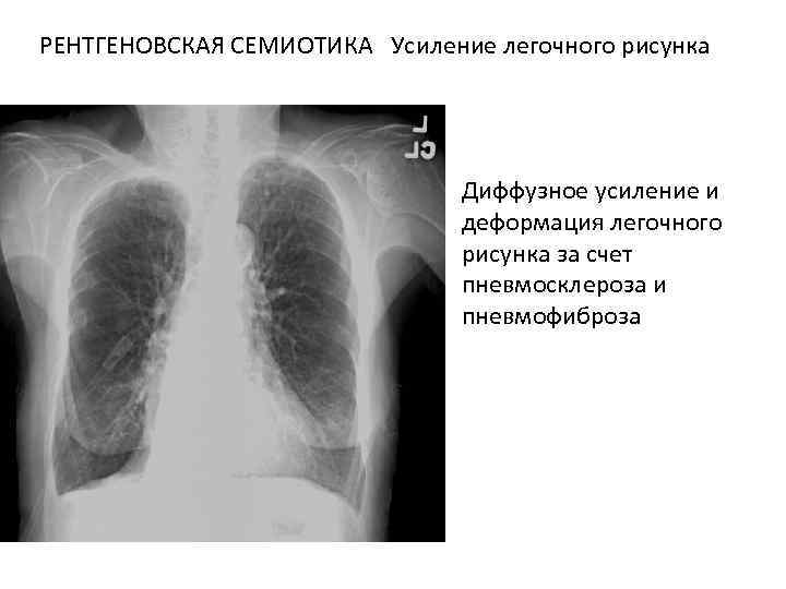 Легочный рисунок диффузно усилен за счет интерстициального компонента