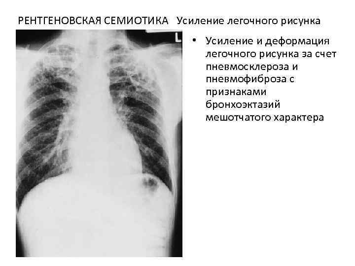 Легочный рисунок несколько деформирован