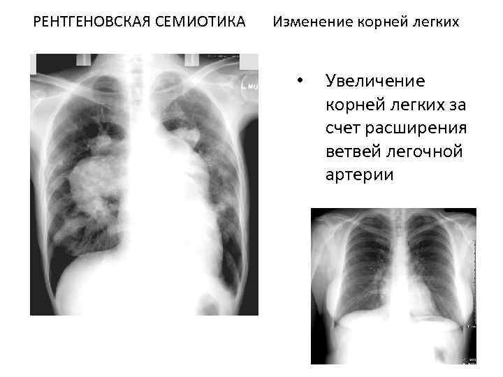 РЕНТГЕНОВСКАЯ СЕМИОТИКА Изменение корней легких • Увеличение корней легких за счет расширения ветвей легочной
