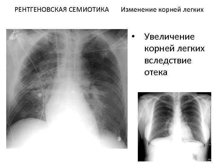 Расширение корня легкого