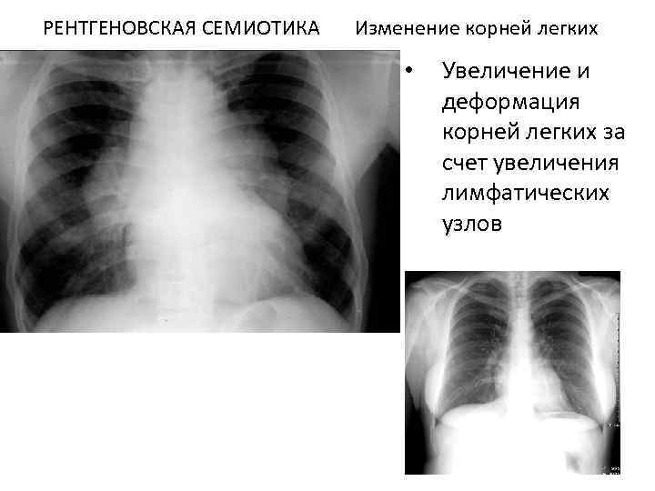 Деформация рисунка легких что это