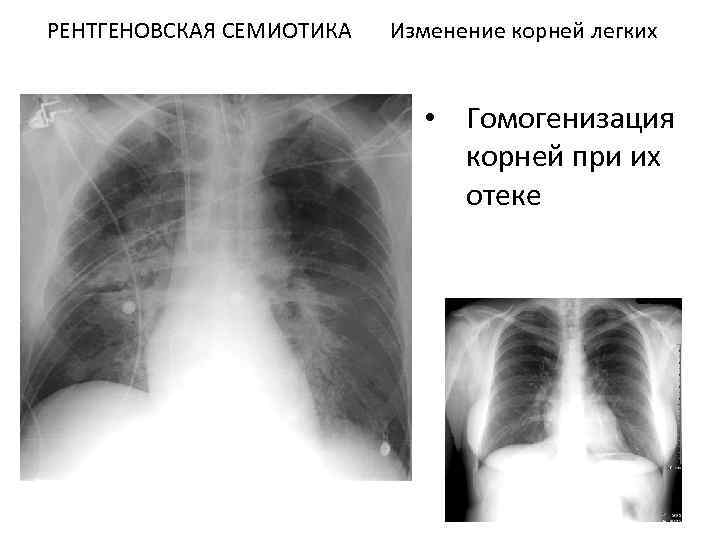 Изменения легочного и корневого рисунка