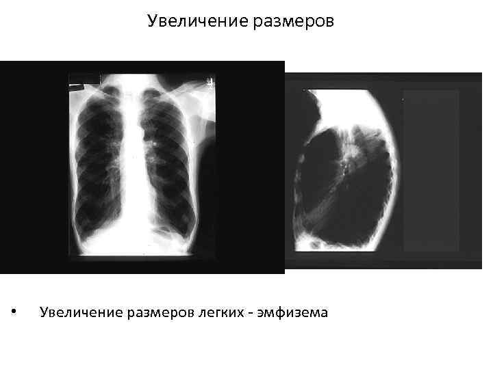 Увеличение размеров • Увеличение размеров легких - эмфизема 