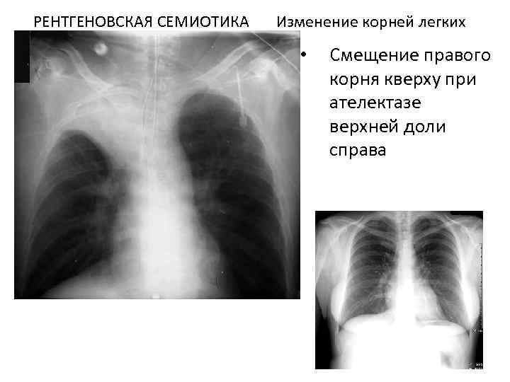 Корни тяжистые легких рисунок изменен