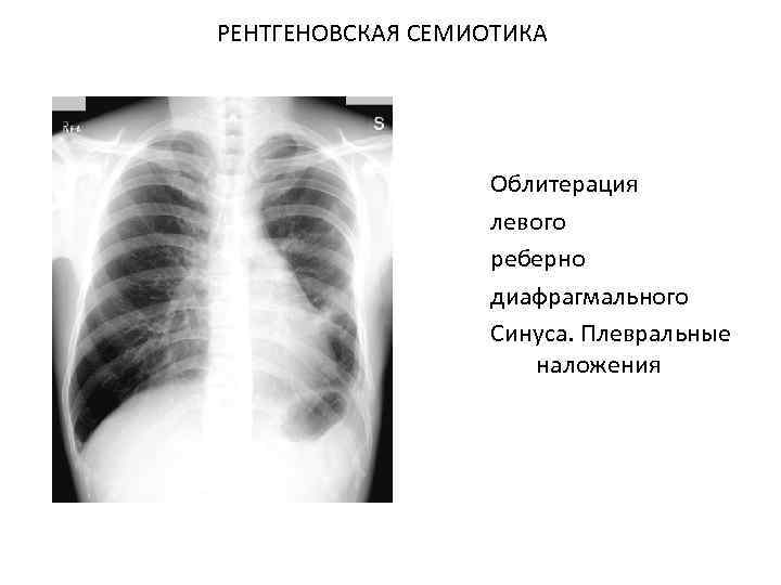 Кардиодиафрагмальный синус. Передние плевральные синусы облитерированы. Реберно-диафрагмальный синус облитерирован. Реберно диафрагмальный угол. Синусы на рентгене легких.