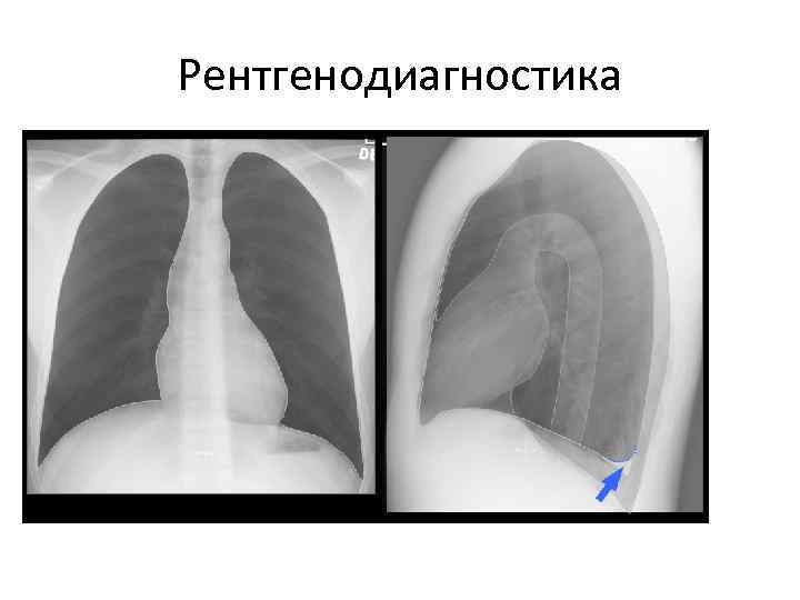 Рентгенологическую картину выпотного плеврита определяют