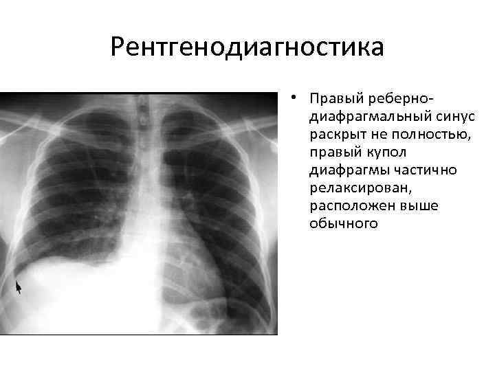Рентгенодиагностика   • Правый реберно-    диафрагмальный синус   