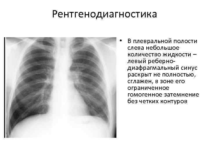 Рентгенодиагностика    • В плевральной полости    слева небольшое 