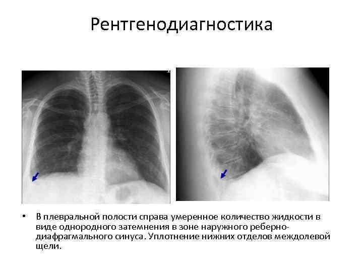    Рентгенодиагностика • В плевральной полости справа умеренное количество жидкости в 