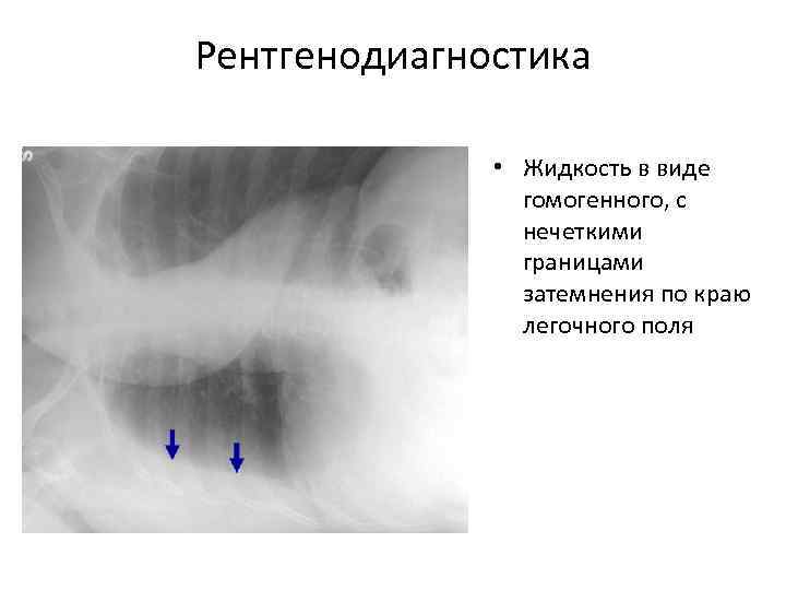 Рентгенодиагностика   • Жидкость в виде   гомогенного, с   нечеткими