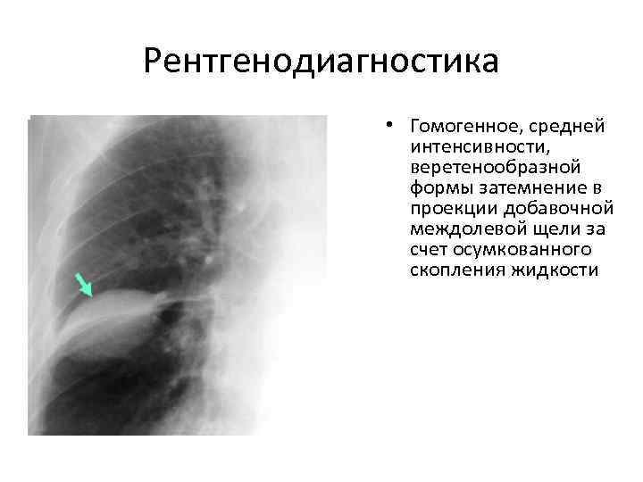 Рентгенодиагностика   • Гомогенное, средней    интенсивности,    веретенообразной