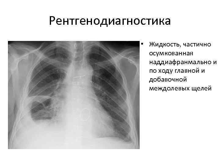 Рентгенодиагностика    • Жидкость, частично   осумкованная   наддиафранмально и