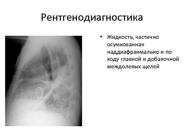 Рентгенодиагностика   • Жидкость, частично   осумкованная   наддиафранмально и по