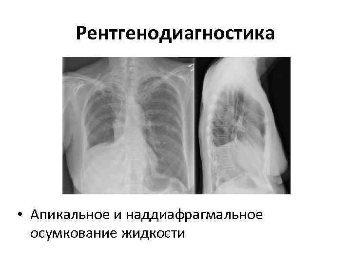   Рентгенодиагностика • Апикальное и наддиафрагмальное  осумкование жидкости 