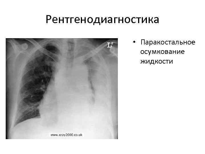 Рентгенодиагностика    • Паракостальное   осумкование   жидкости 