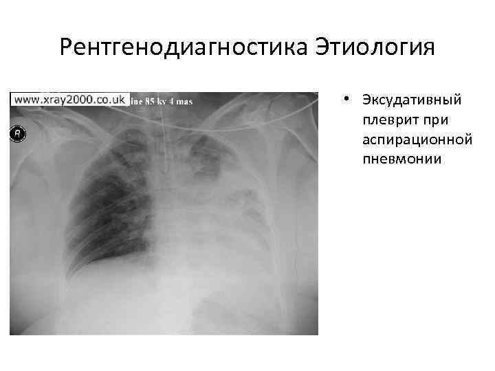 Рентгенодиагностика Этиология    • Эксудативный    плеврит при  