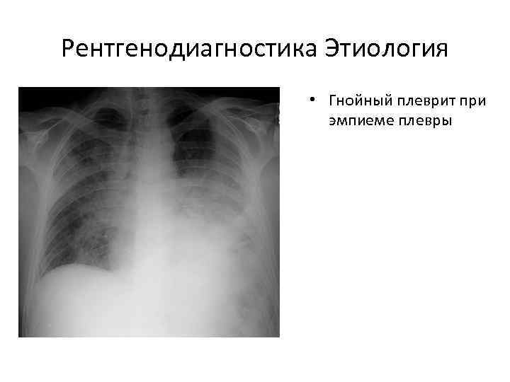 Рентгенодиагностика Этиология    • Гнойный плеврит при     эмпиеме