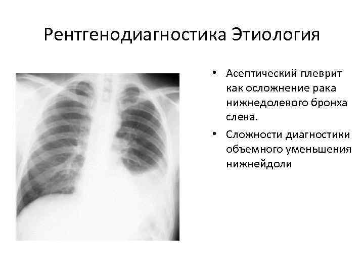 Рентгенодиагностика Этиология    • Асептический плеврит    как осложнение рака